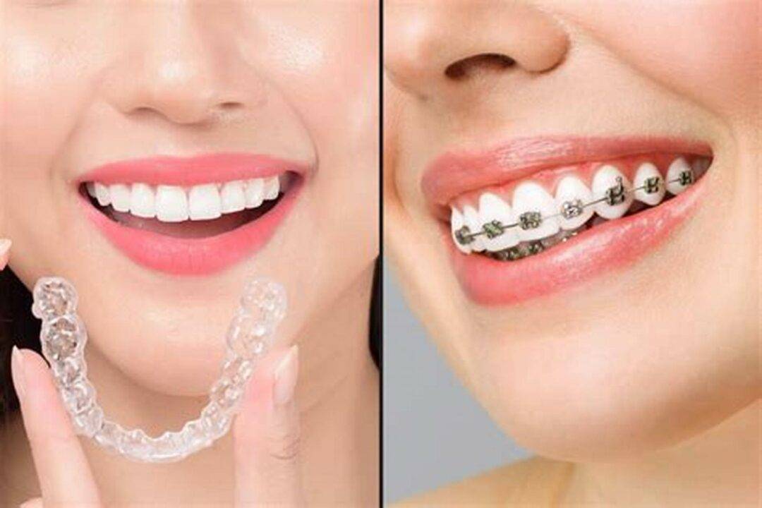 Clear Aligners Vs Traditional Braces Choosing The Right Orthodontic