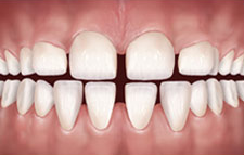 gaps-teeth