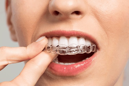 Advancements in Aligner Technology