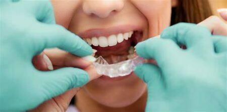 Clear Aligner Process