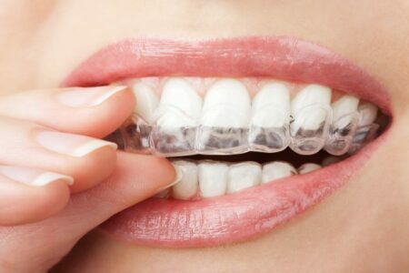 advantages of aligners