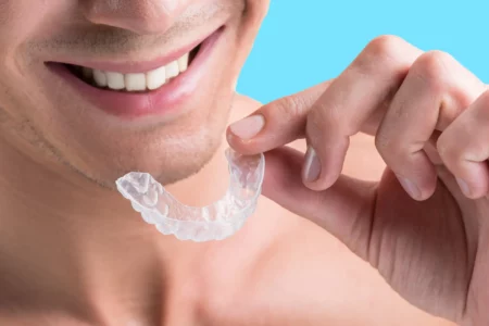 clear aligners