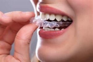 clear aligners marketing