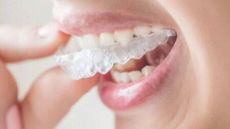 Clear Aligners - Invisible Braces - Fairhaven Dental