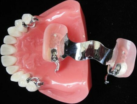 Orthodontic Attachments