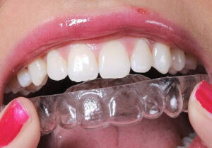 Recommendations for clear aligner therapy