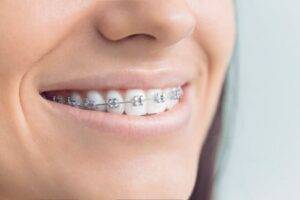 Traditional-metal-braces