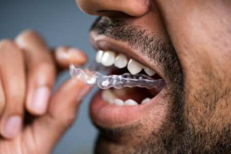 clear education about clear aligners
