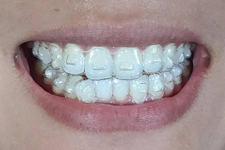 role of aligner attachments