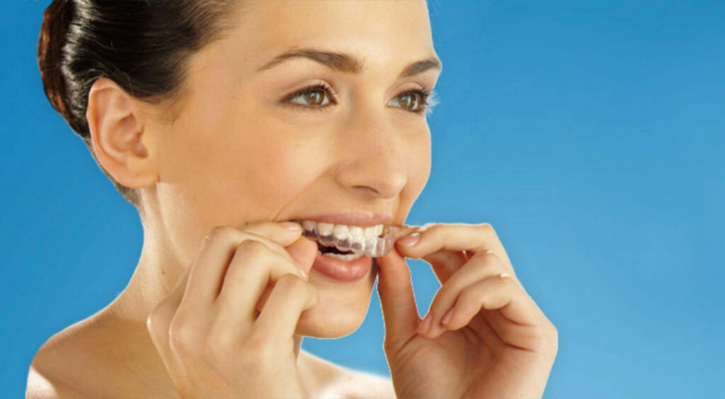 Clear Aligners and Periodontal Health