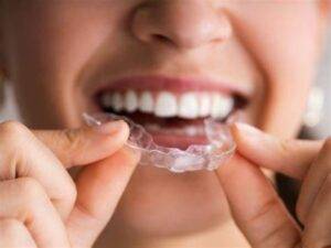 clear aligners