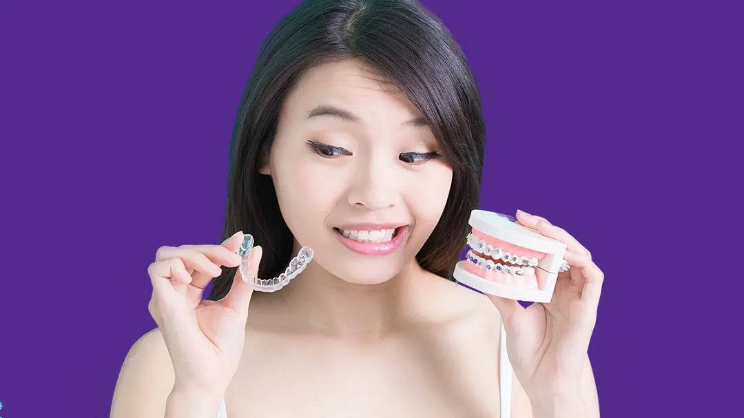 Switching from Braces to Clear Aligners What to Expect?