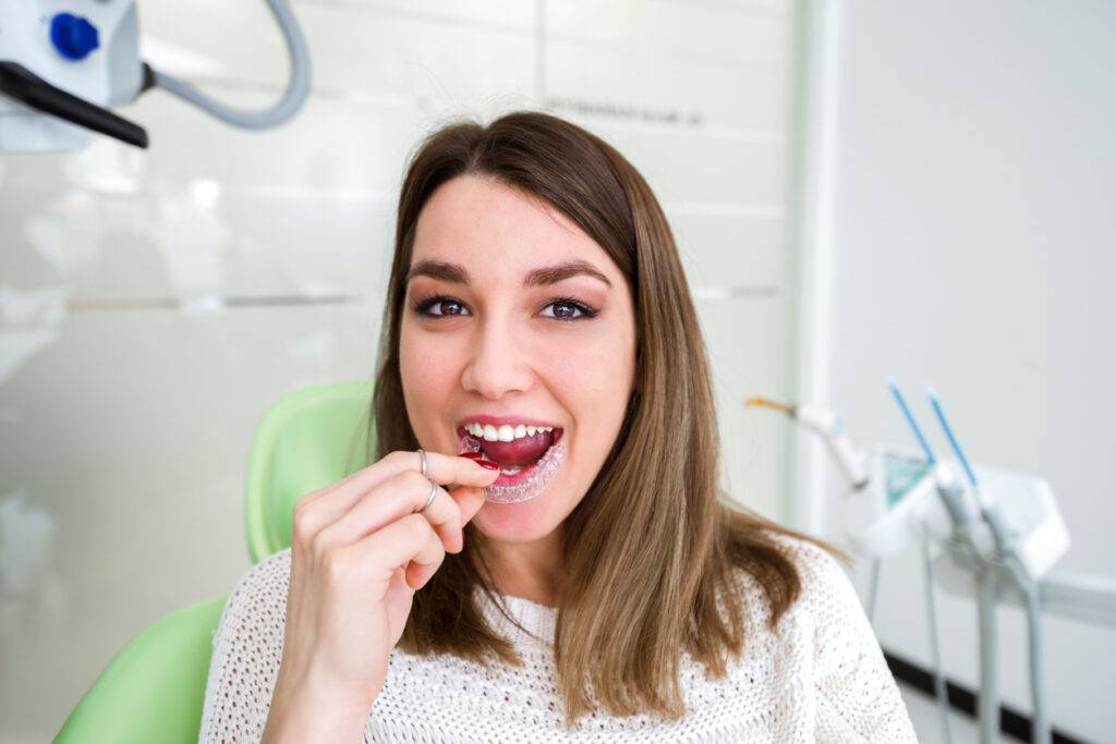 Open bite treatment using clear aligners