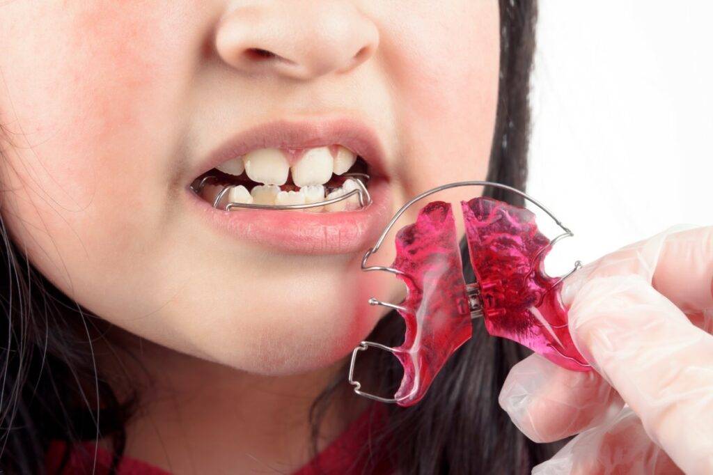 Orthodontic Retainers