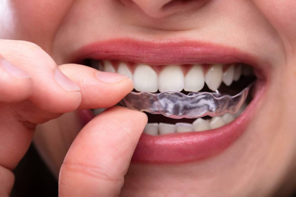 The Advantages of Clear Aligners Over Traditional Braces