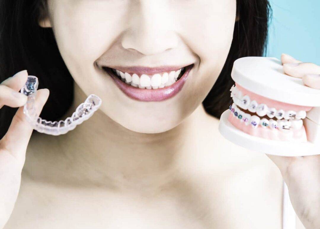 Clear Aligners vs Traditional Braces