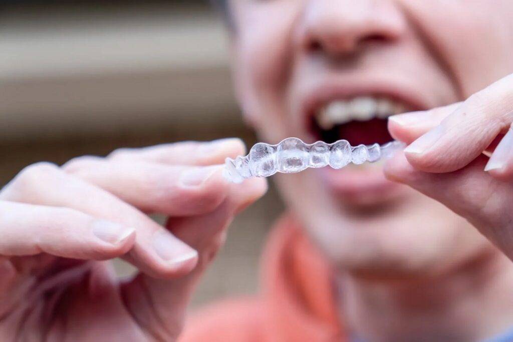 The Ultimate Guide to Clear Aligners