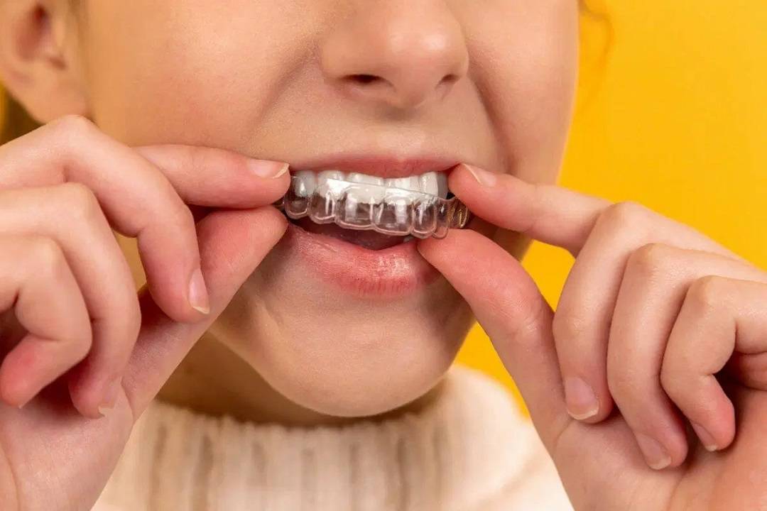 Environmental Impact of Clear Aligners