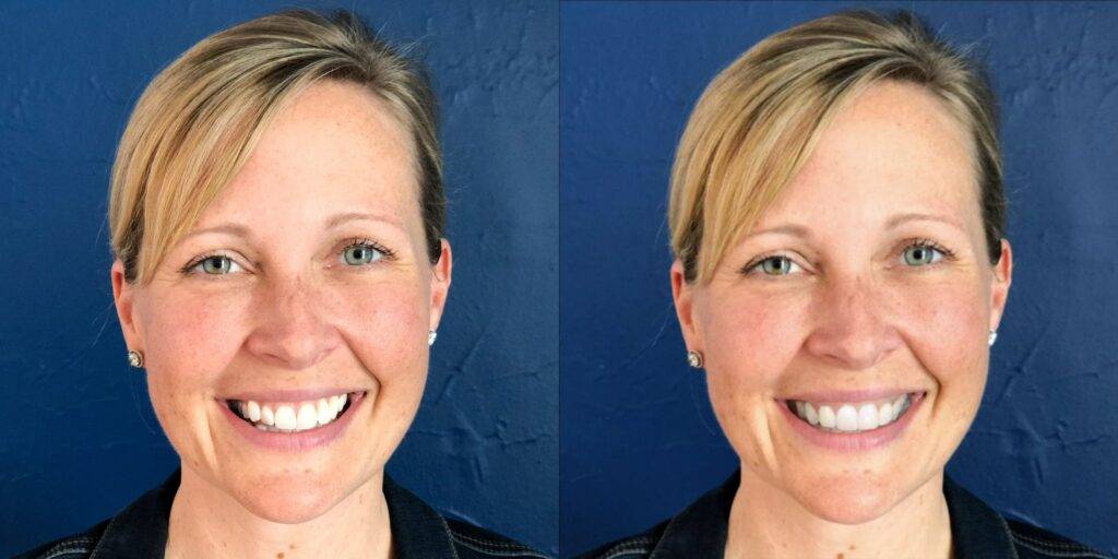How Smile Simulations Improve Patient Communication and Trust