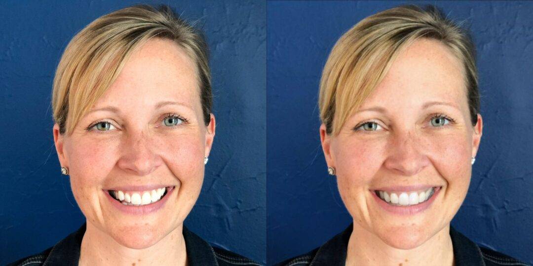 How Smile Simulations Improve Patient Communication and Trust