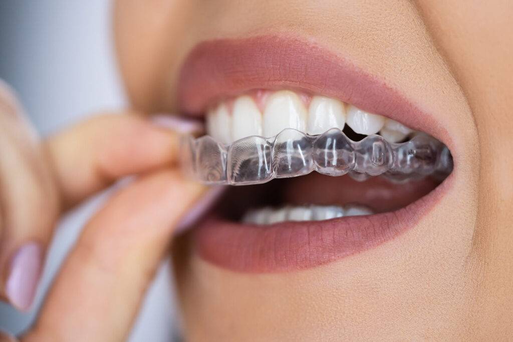 Right Clear Aligner