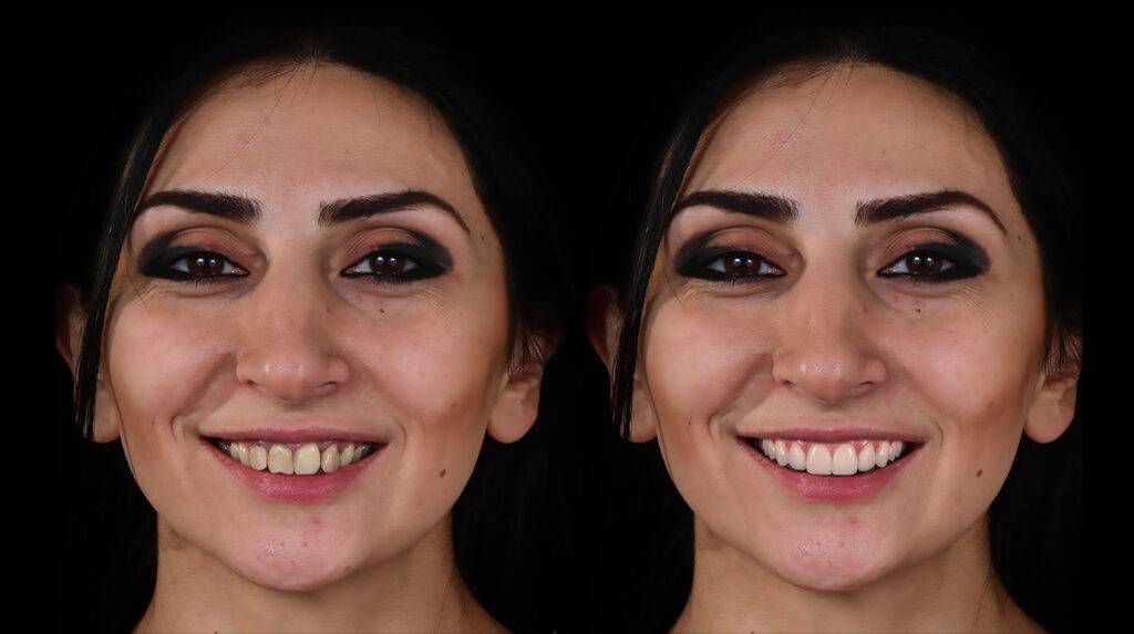 Smile Simulation Software